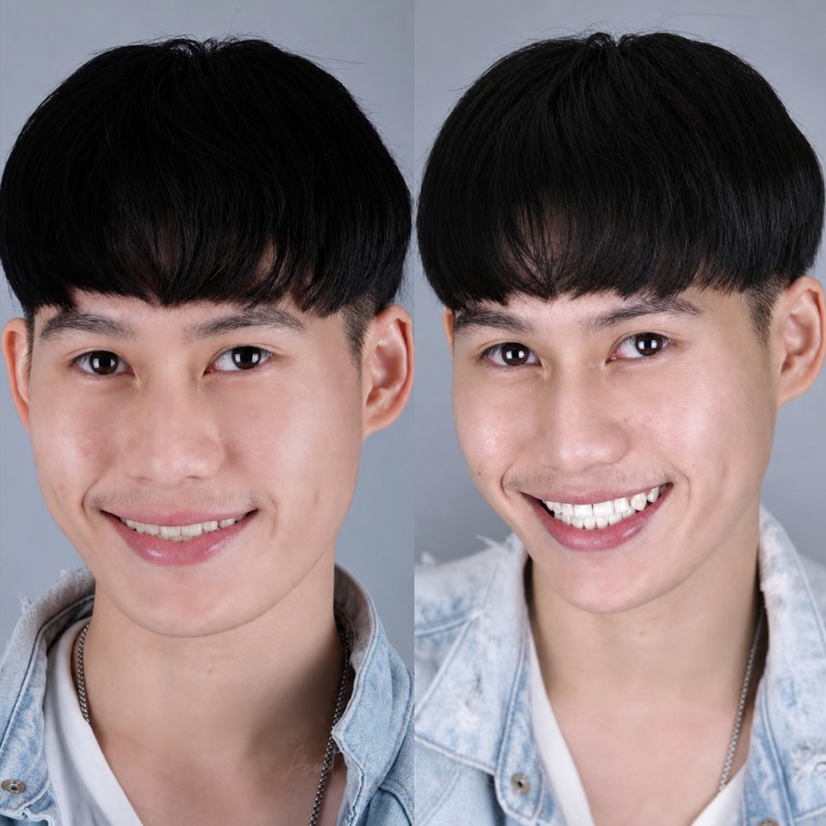 Resultados de blanqueamiento dental antes y después en About Tooth Dental Clinic, sonrisa brillante