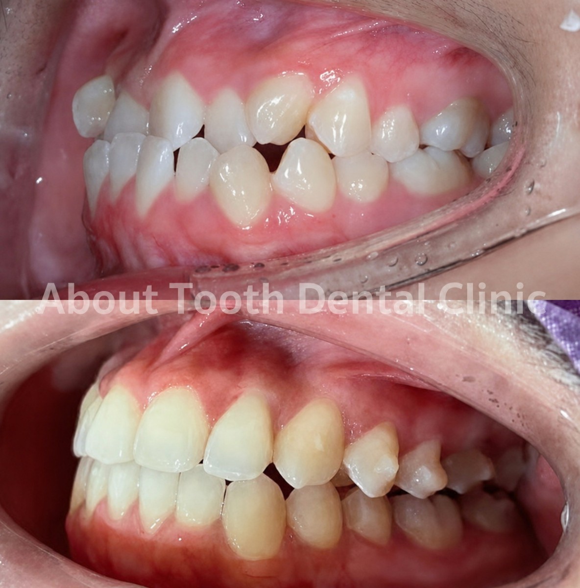 Before and after Invisalign results at About Tooth Dental Clinic – improved teeth alignment