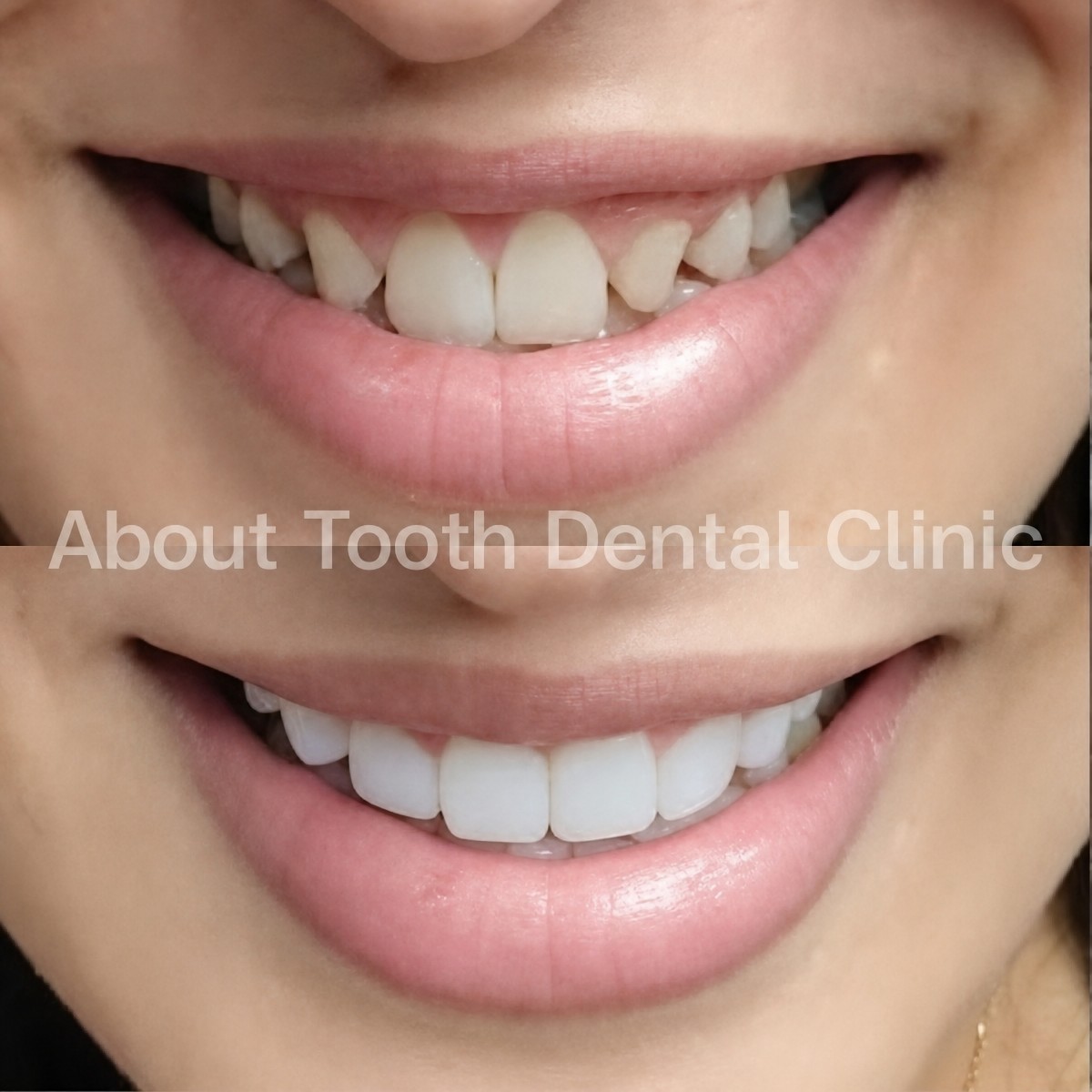 Результаты до и после композитных виниров в About Tooth Dental Clinic, преображение улыбки