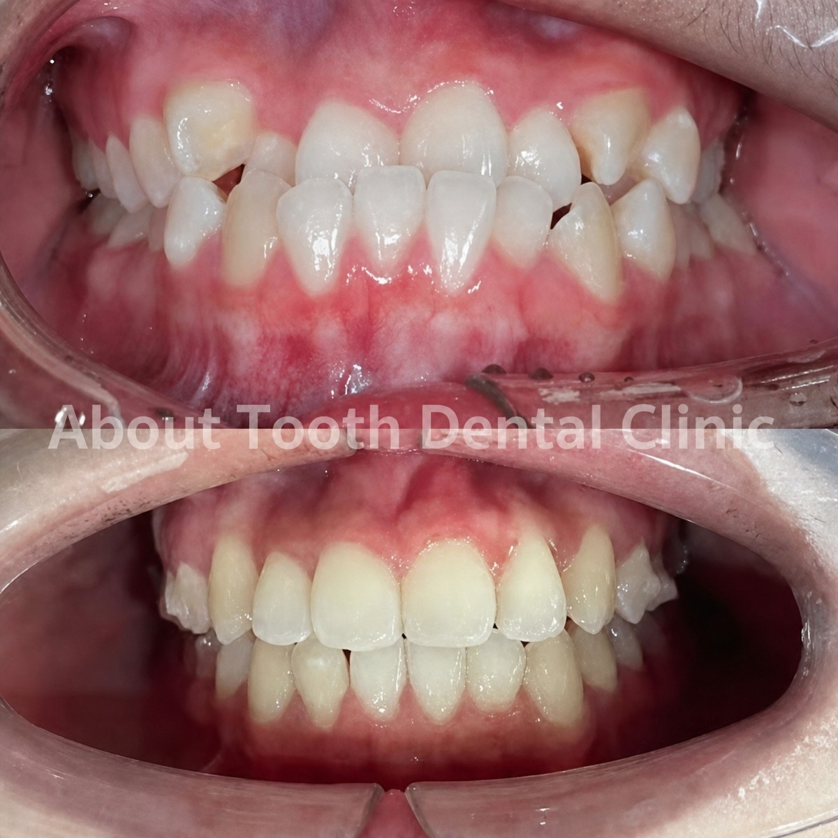 Before and after Invisalign results at About Tooth Dental Clinic – straighter teeth alignment