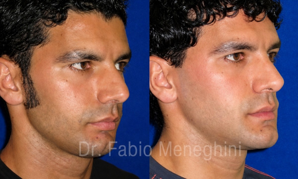 Vorher-nachher-Rhinoplastik-Ergebnisse bei Maria Cecilia Hospital, verbesserte Nasenform für Männer