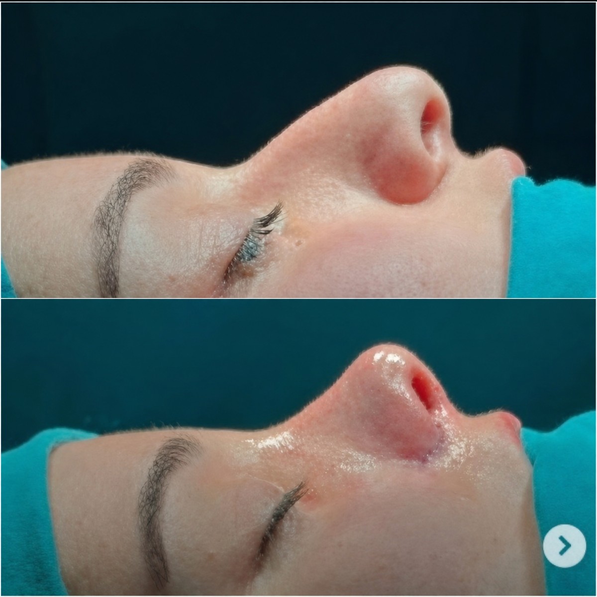 Before and after rhinoplasty results at Biruni University Hospital, nose reshaping procedure