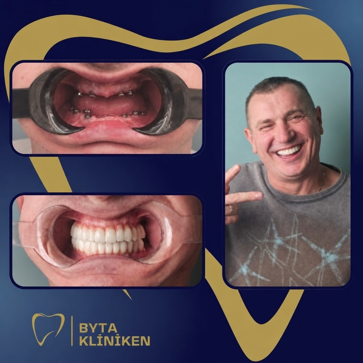 Before and after Nobel Biocare dental implants at KLİNİKEN, full smile restoration result