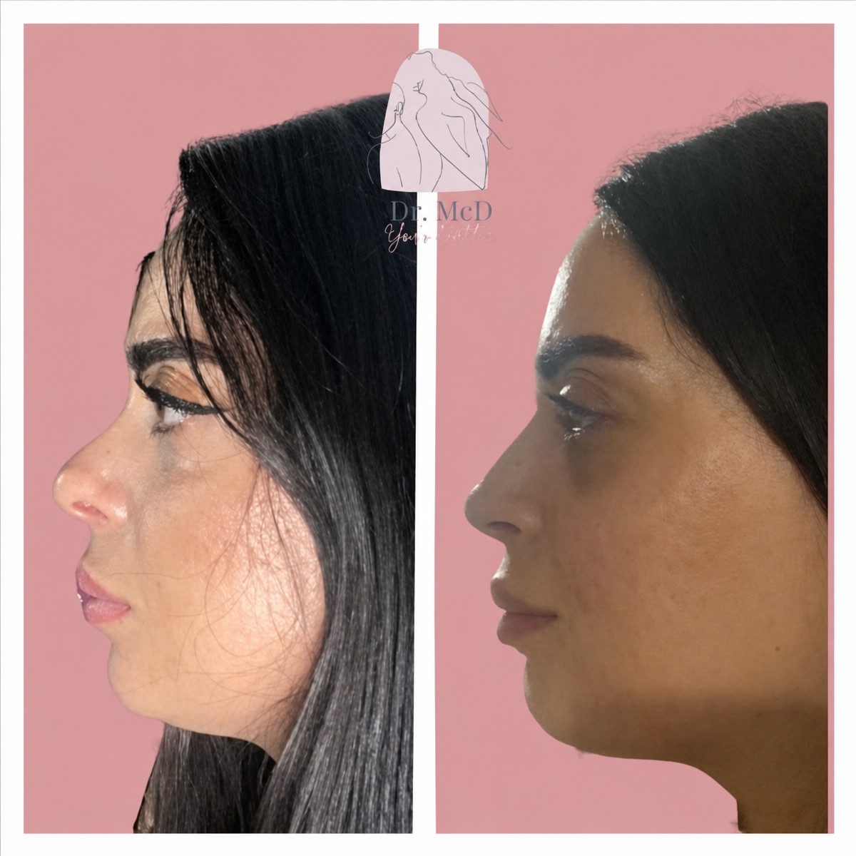 Resultados de rinoplastia antes y después en Dr. MED, perfil nasal mejorado