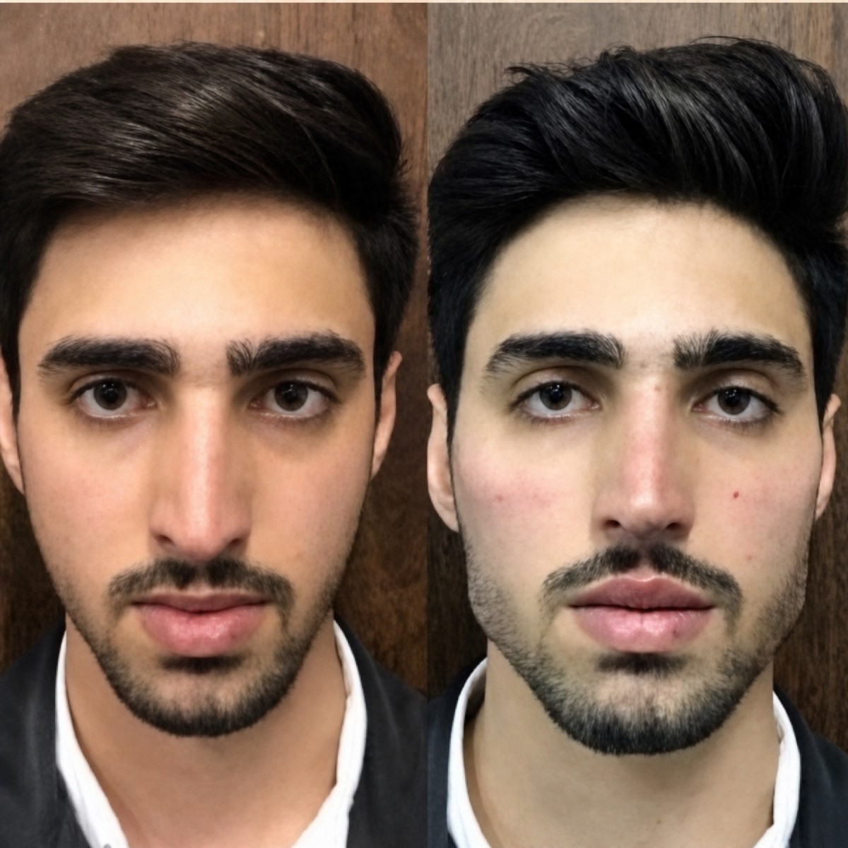 Before and after septoplasty results at ID Clinic Bangkok, improved nasal symmetry and breathing