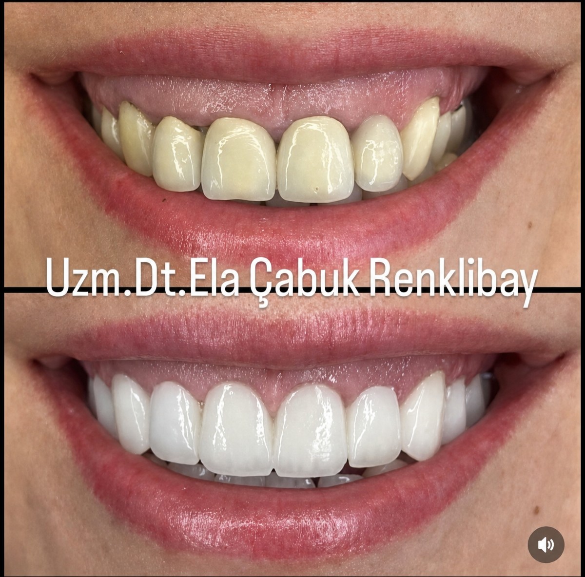 Résultats avant et après gingivectomie à la clinique privée Dr Ela Cabuk Renklibay