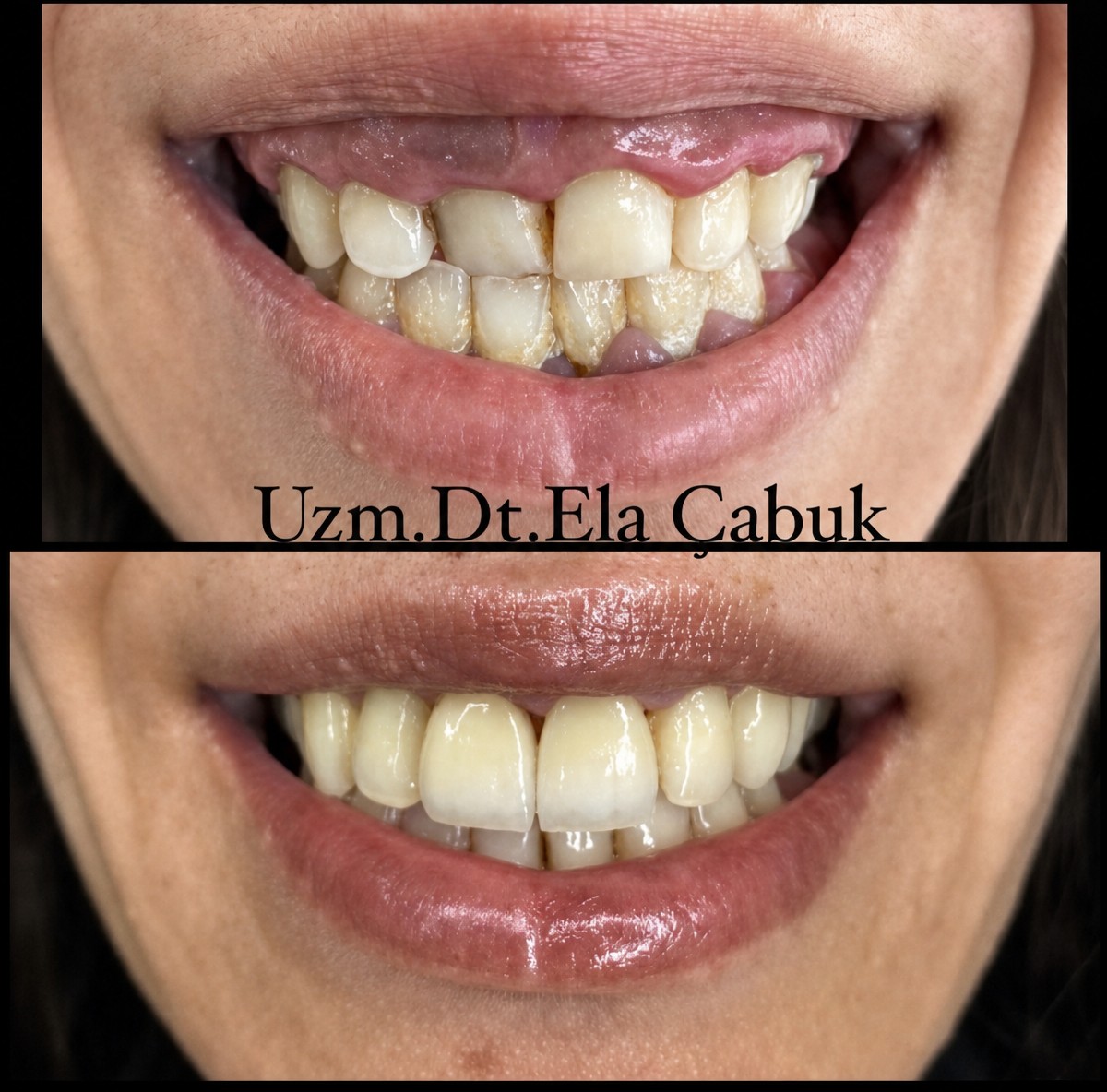 Before and after crown lengthening results at Dr. Ela Cabuk Renklibay's Private Dental Clinic