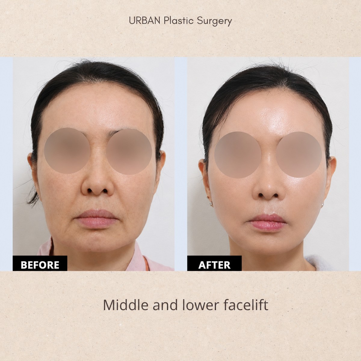 Before and after middle and lower facelift results at URBAN Plastic Surgery, facial rejuvenation
