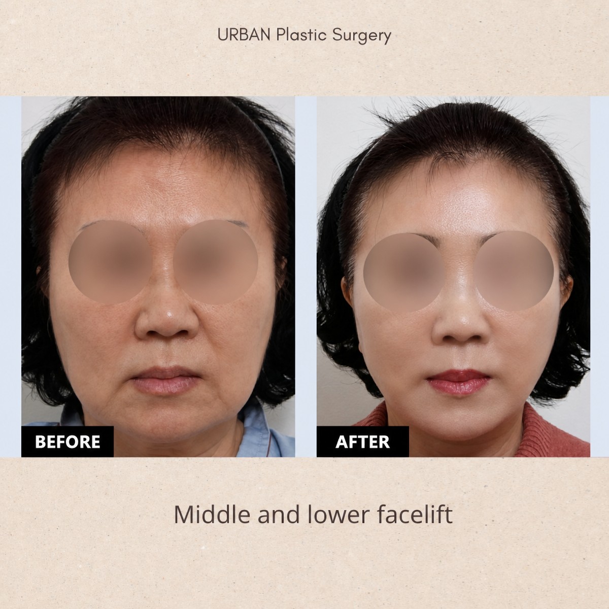 Before and after middle and lower facelift results at URBAN Plastic Surgery, facial rejuvenation