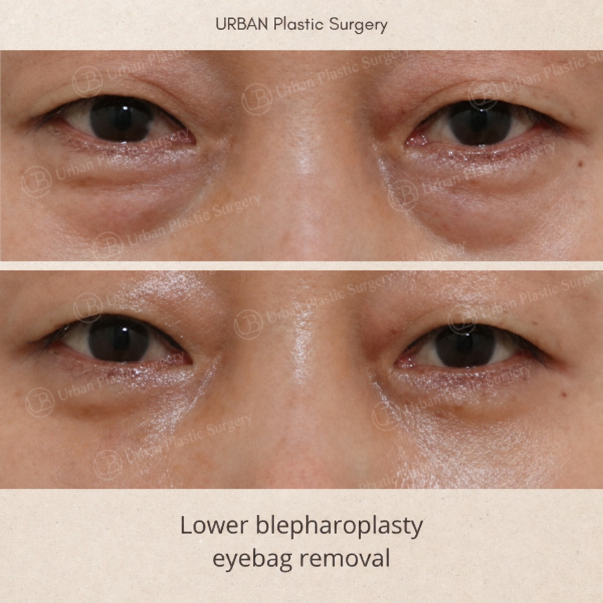 Résultat avant/après blépharoplastie inférieure chez URBAN Plastic Surgery, poches retirées