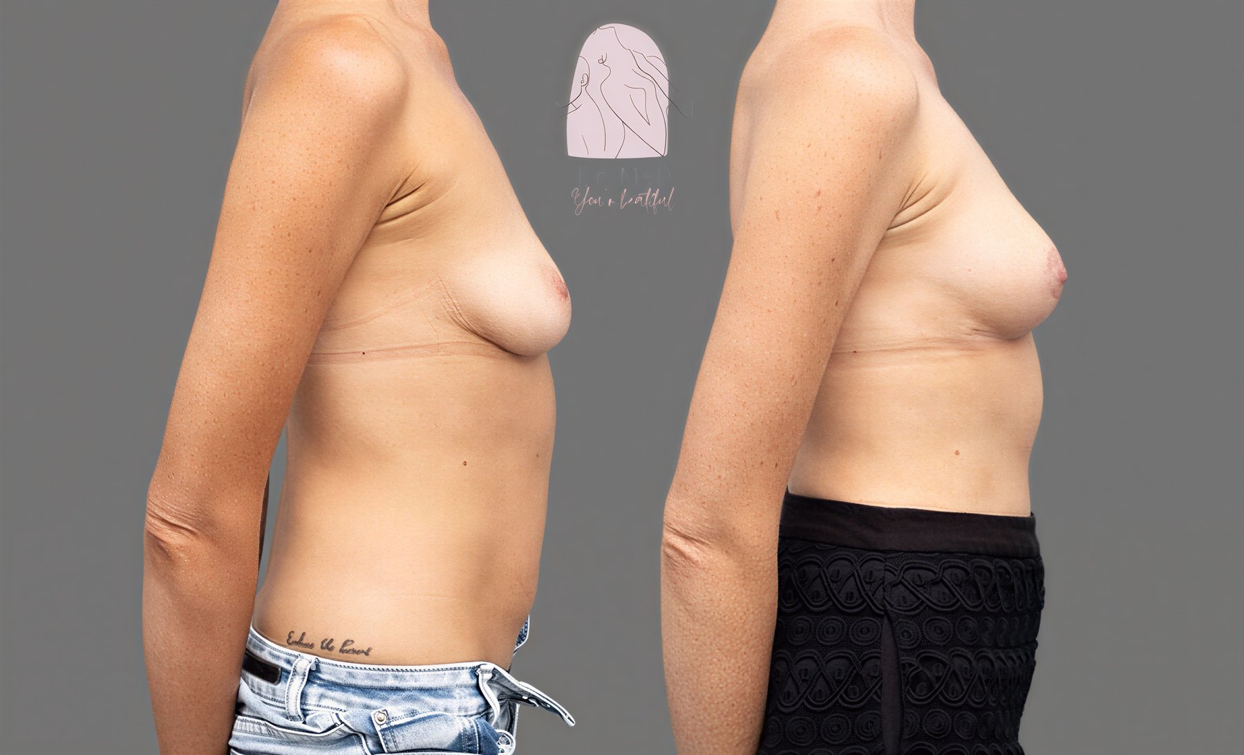 Antes y después de aumento de senos con transferencia de grasa en Dr. MED, resultado natural