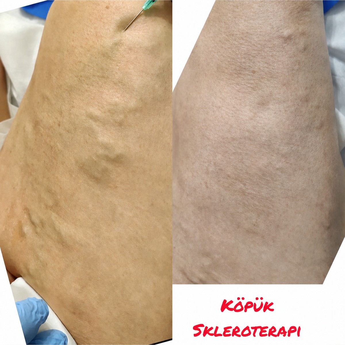 قبل وبعد علاج الدوالي بالتصليب في Vein Clinic Alanya، نتيجة واضحة
