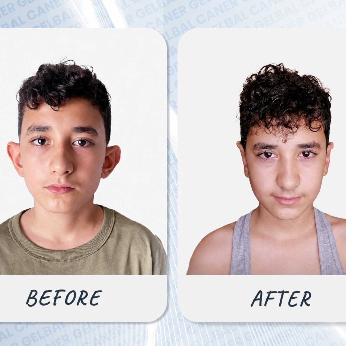 Before and after otoplasty results at Medipol Bahçelievler Hospital, ear reshaping surgery