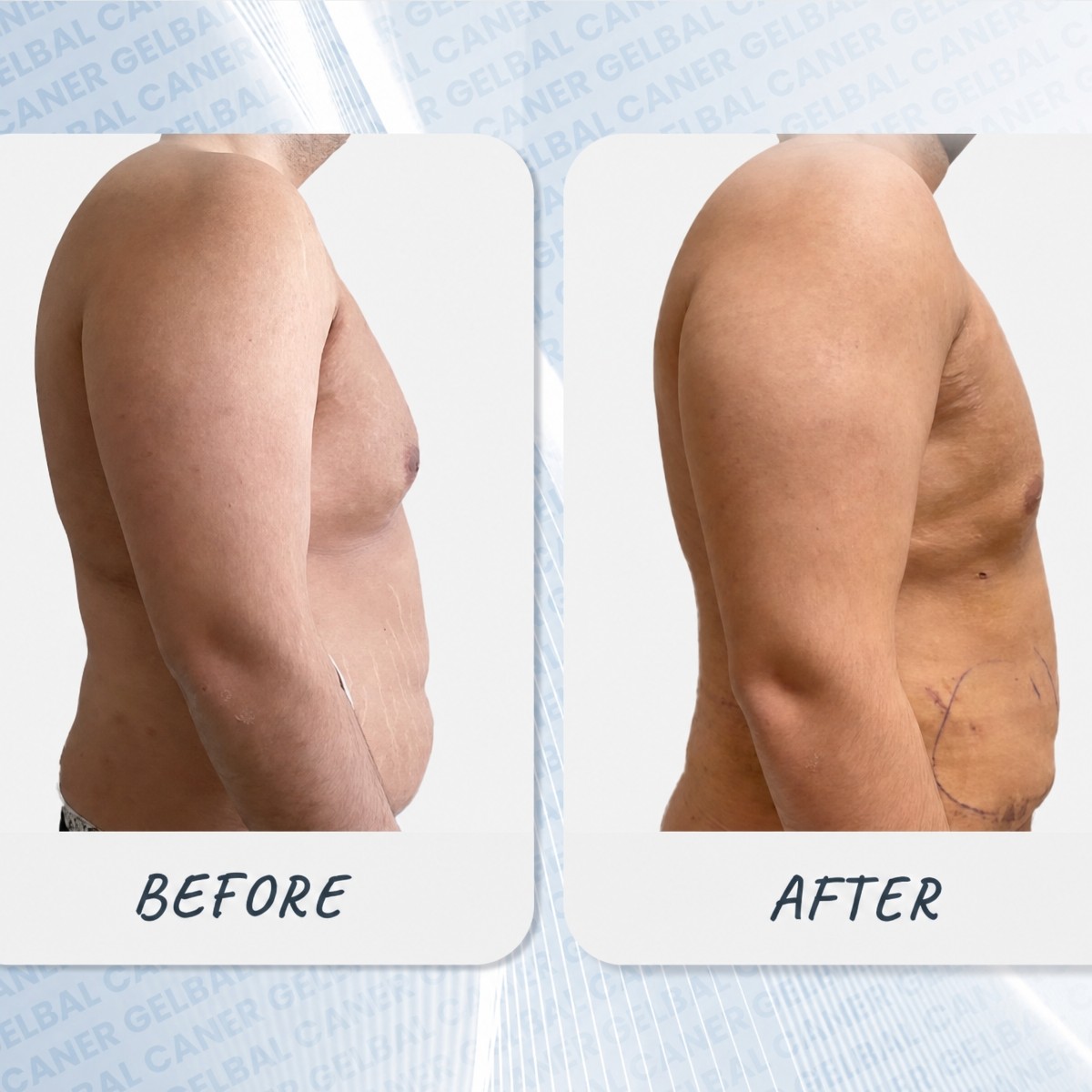Gynecomastia surgery before and after results at Medipol Bahçelievler Hospital, chest contour