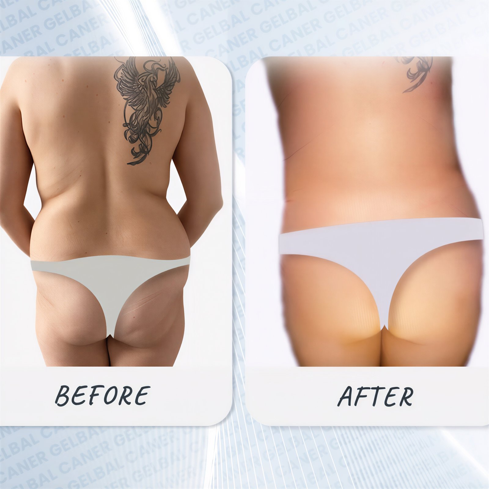نتائج قبل وبعد عملية Brazilian Butt Lift في مستشفى Medipol Bahçelievler، تحسين المنحنيات