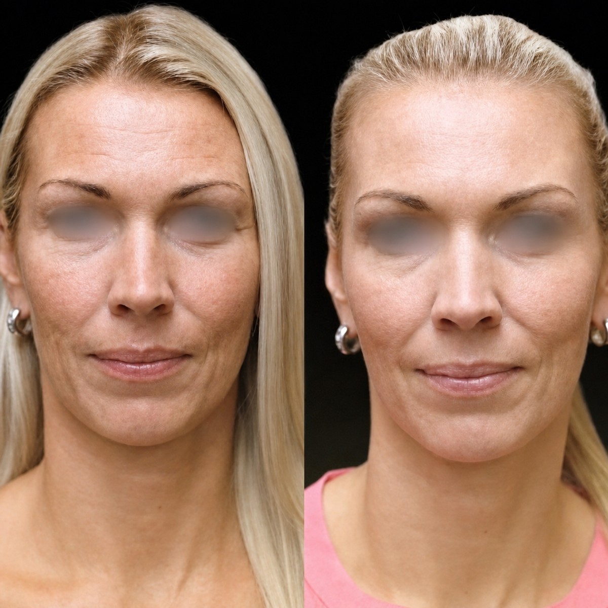 Before and after lipofilling results at Memorial Bahçelievler Hospital, facial fat grafting
