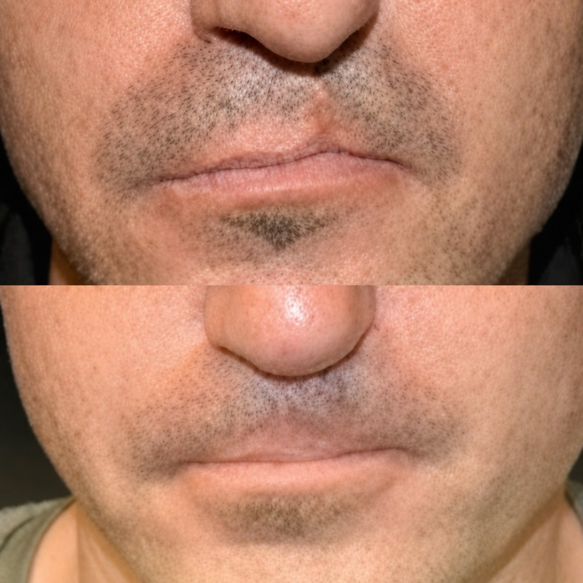 Before and after cleft lip repair results at Memorial Şişli Hospital, improved lip symmetry