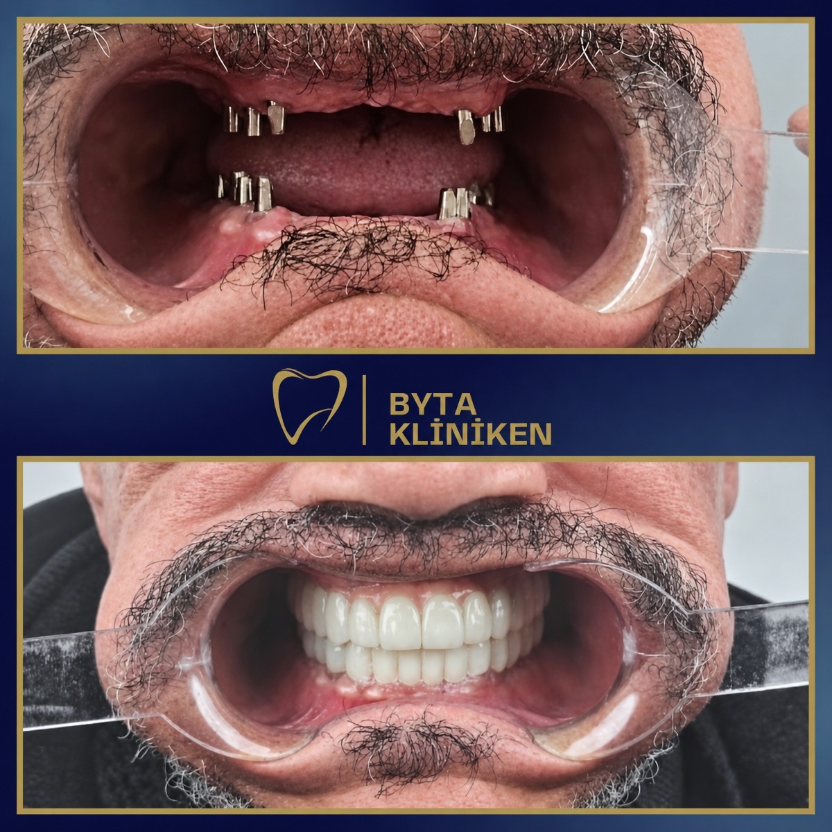 Efekt przed i po implantach All-on-4 w KLİNİKEN, pełna odbudowa uśmiechu