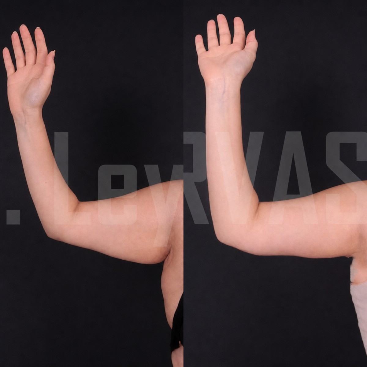 Before and after arm lift (brachioplasty) results at Quartz Hospital, improved arm contour