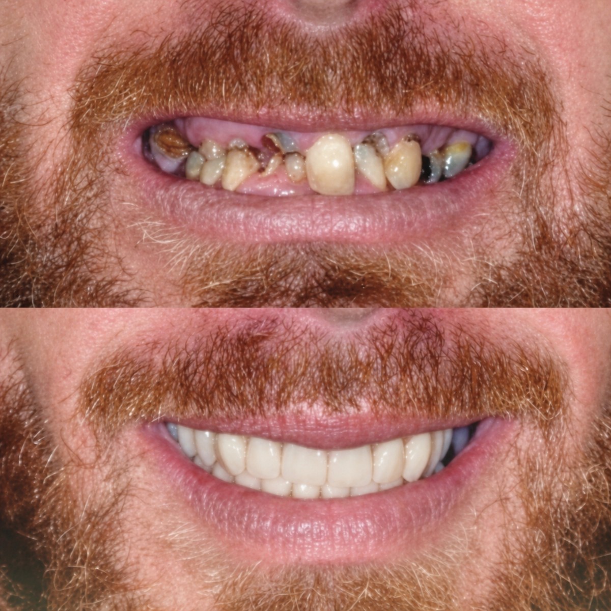 Before and after dental crown installation results at Memorial Bahçelievler Hospital, smile restored