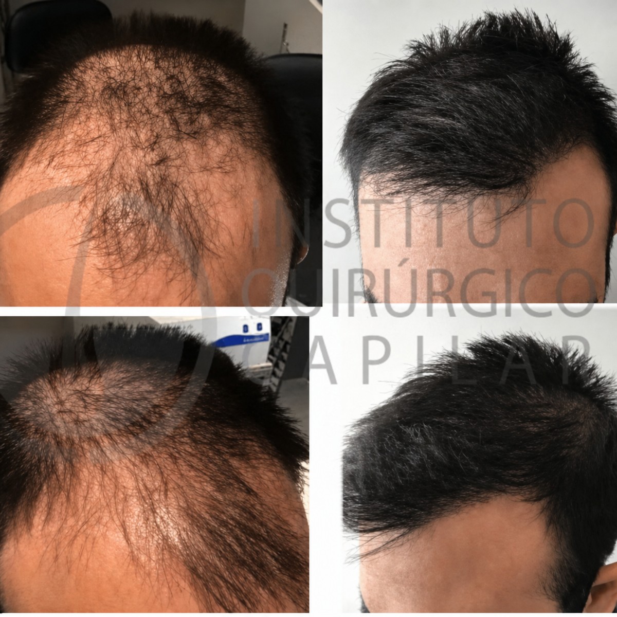نتائج زراعة الشعر قبل وبعد في Centro Médico Teknon، استعادة خط وكثافة الشعر
