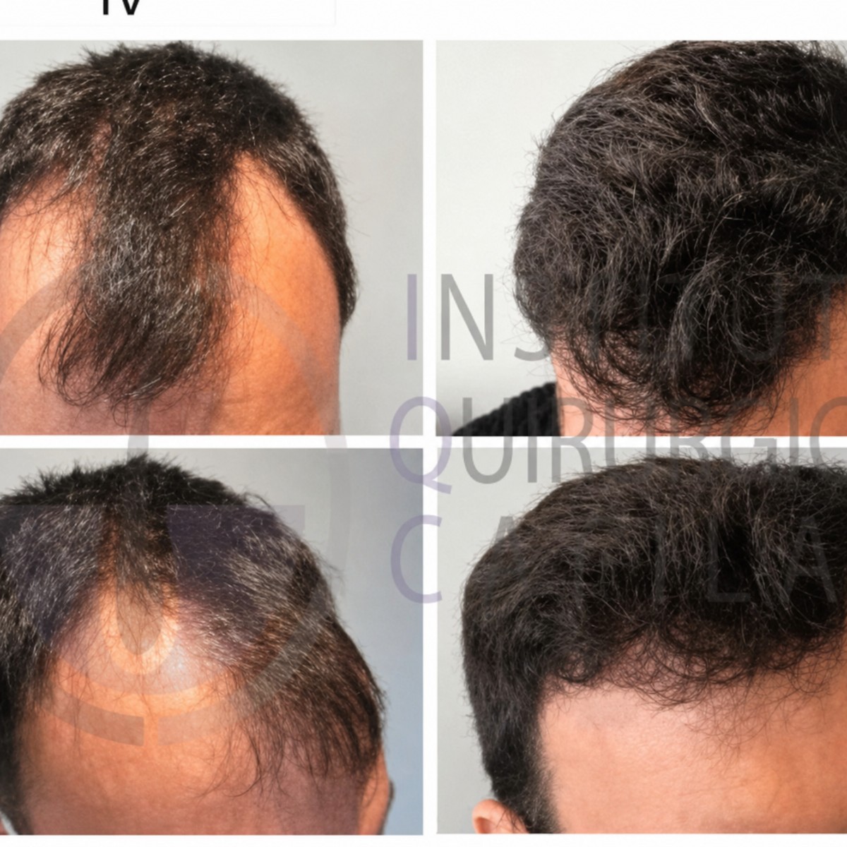 نتائج زراعة الشعر قبل وبعد في Centro Médico Teknon، استعادة خط الشعر للرجال