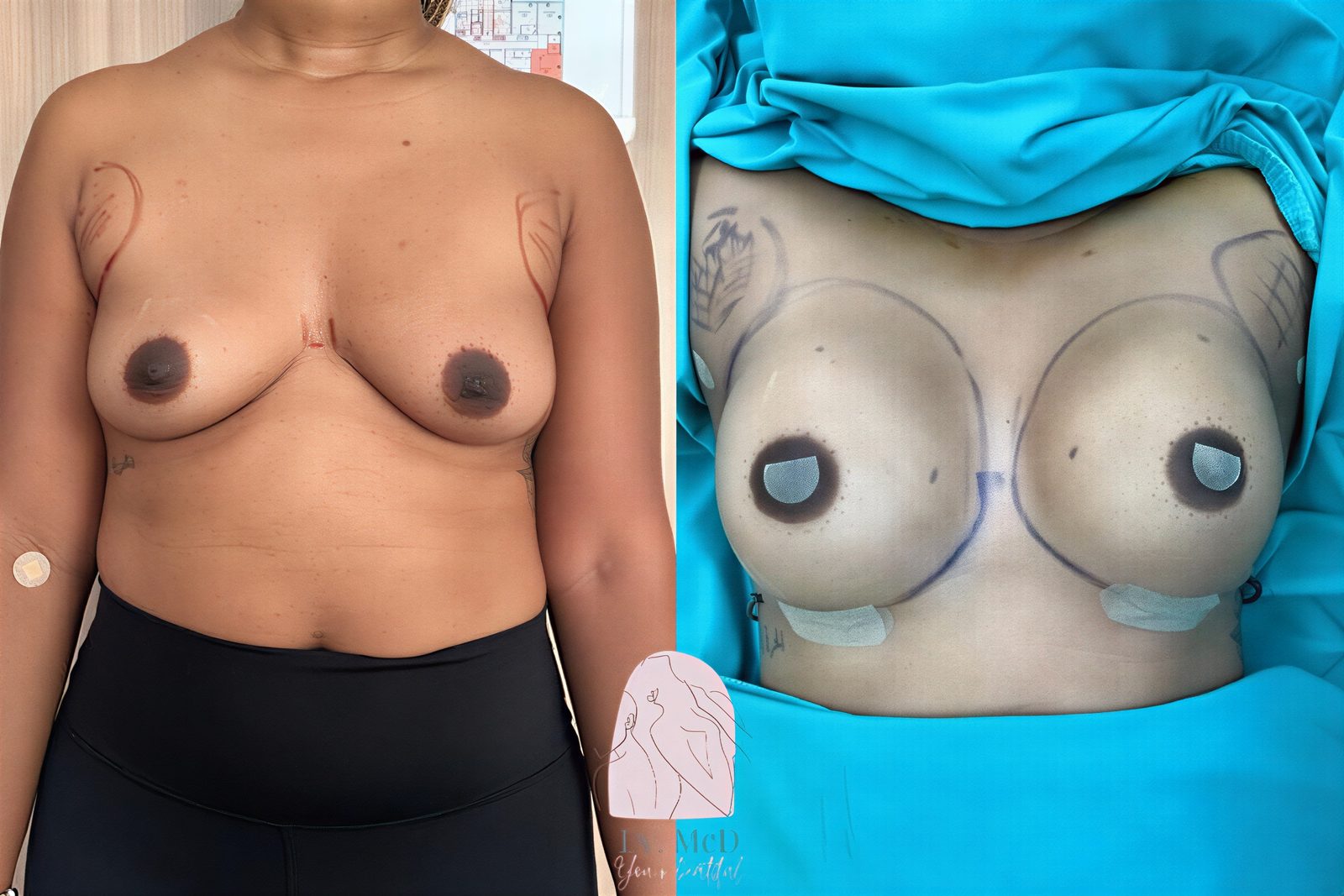 Antes y después de implantes mamarios con lifting en Dr. MED – mejora de la forma