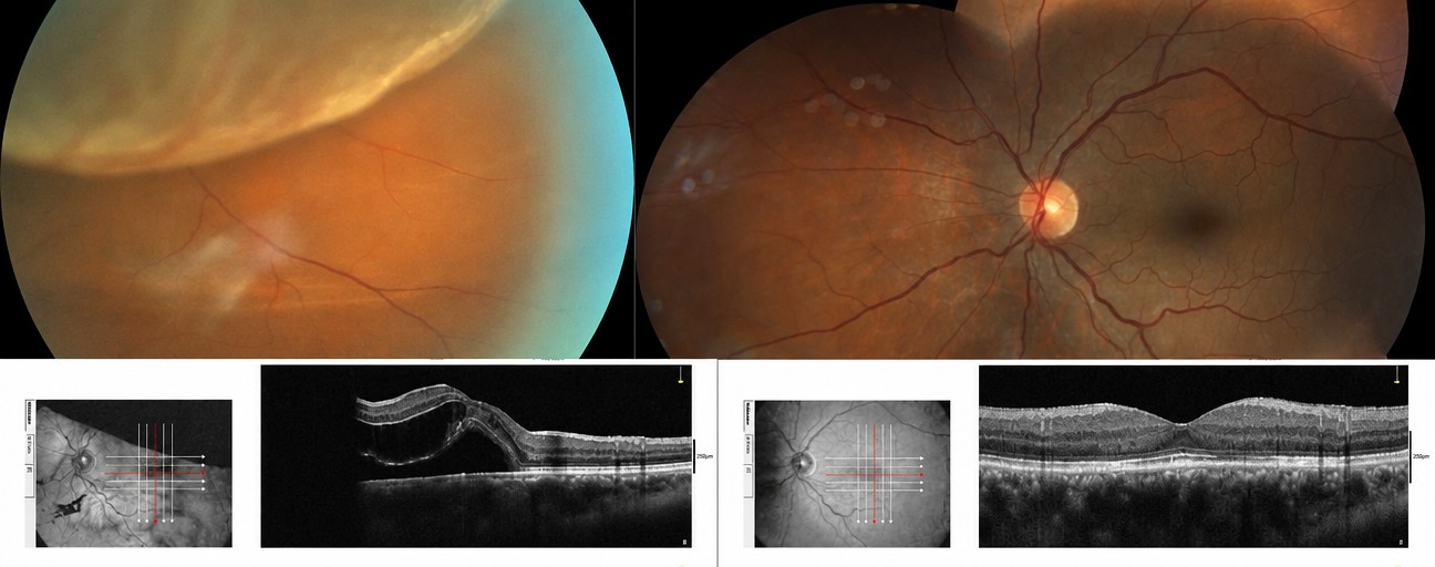 Resultados antes y después de cirugía de desprendimiento de retina en Associate Professor M. Derda Ozer DERDA SAGLIK HIZMETLERI