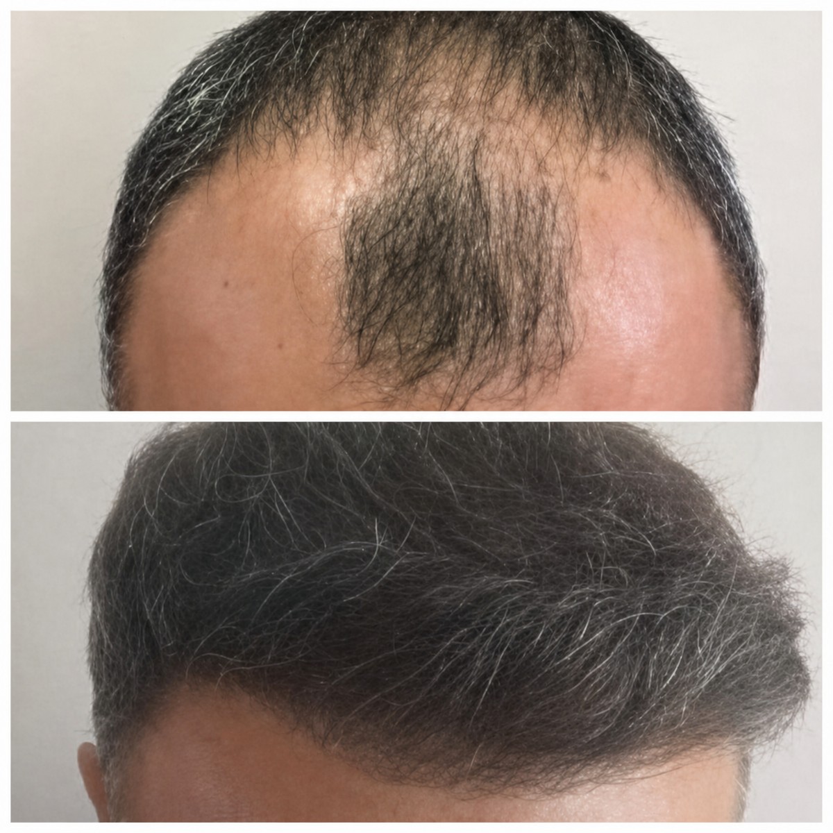 Resultado de trasplante capilar antes y después en Private Medicabil Hospital, línea restaurada