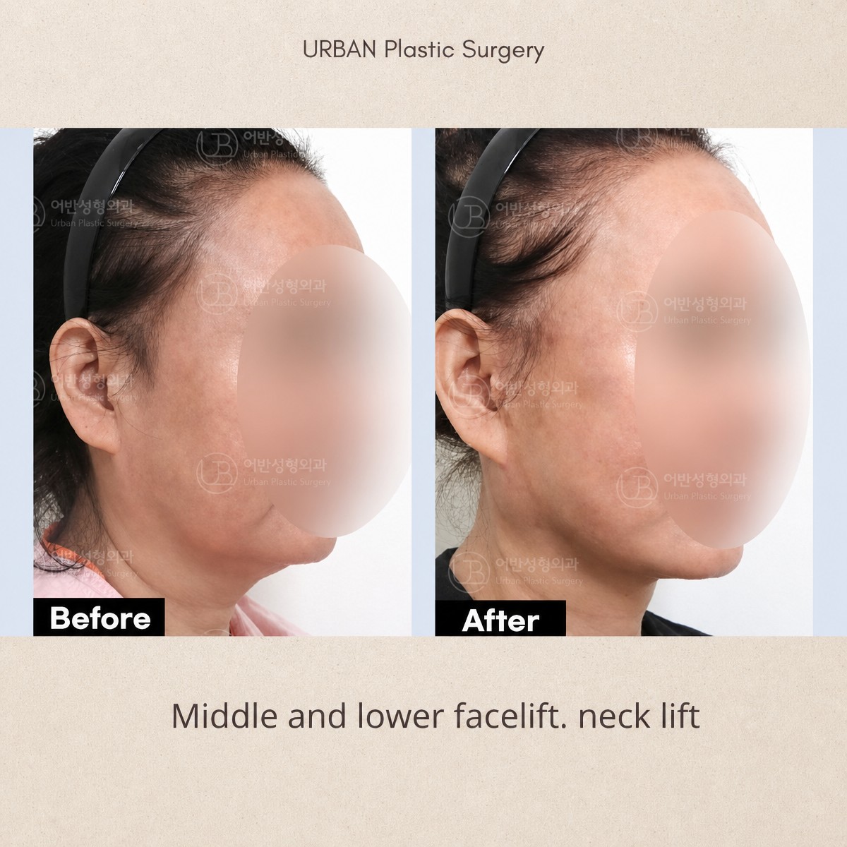 Efekty liftingu twarzy i szyi przed i po w URBAN Plastic Surgery, poprawa linii żuchwy