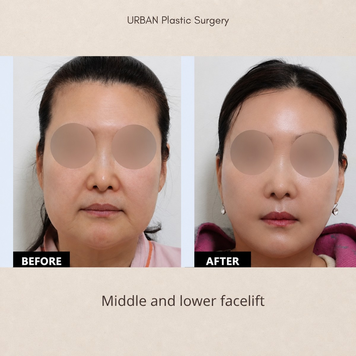Vorher-nachher-Ergebnis Mittel- und Untergesichts-Lifting bei URBAN Plastic Surgery