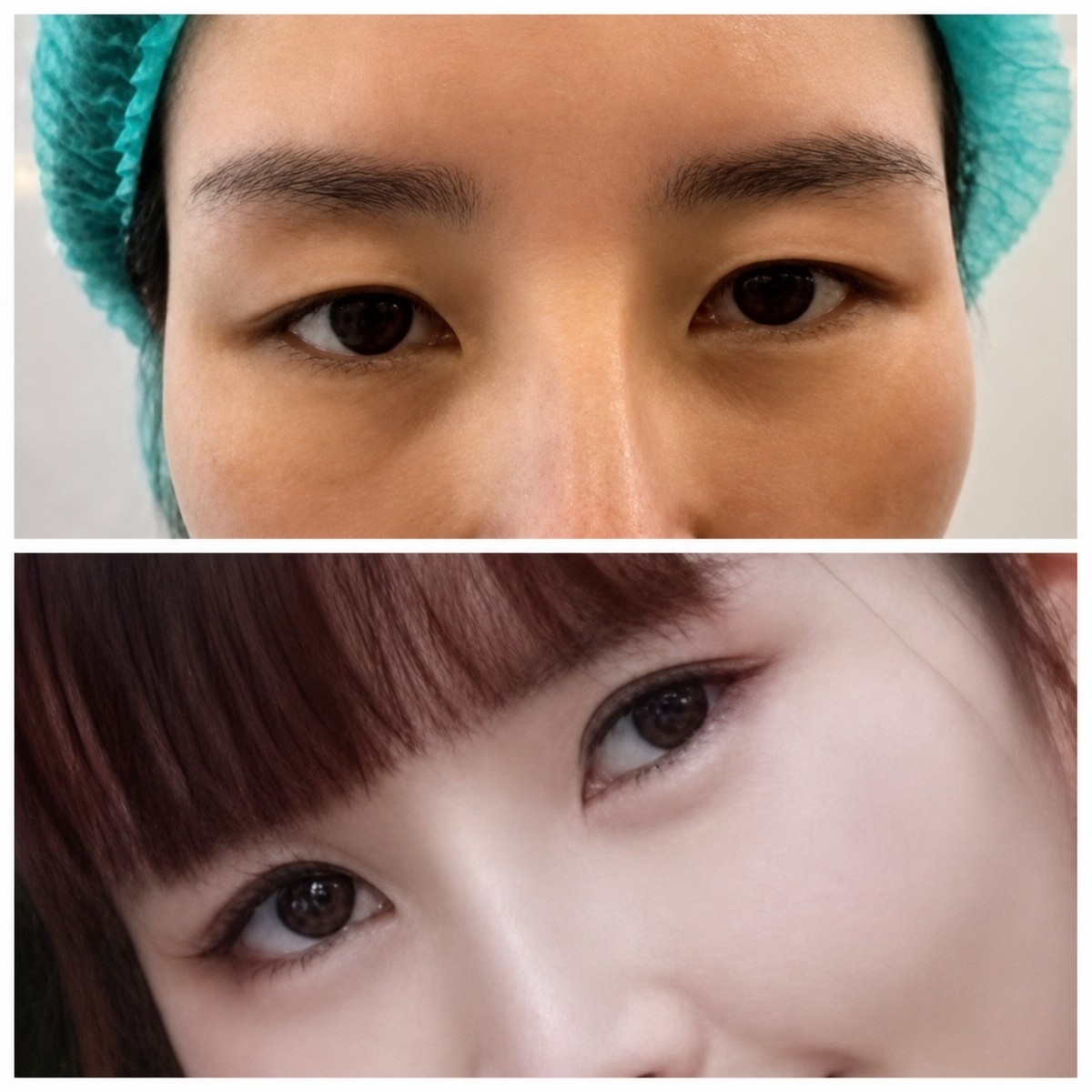 Before and after double eyelid surgery results at ID Clinic Bangkok, enhanced eye appearance