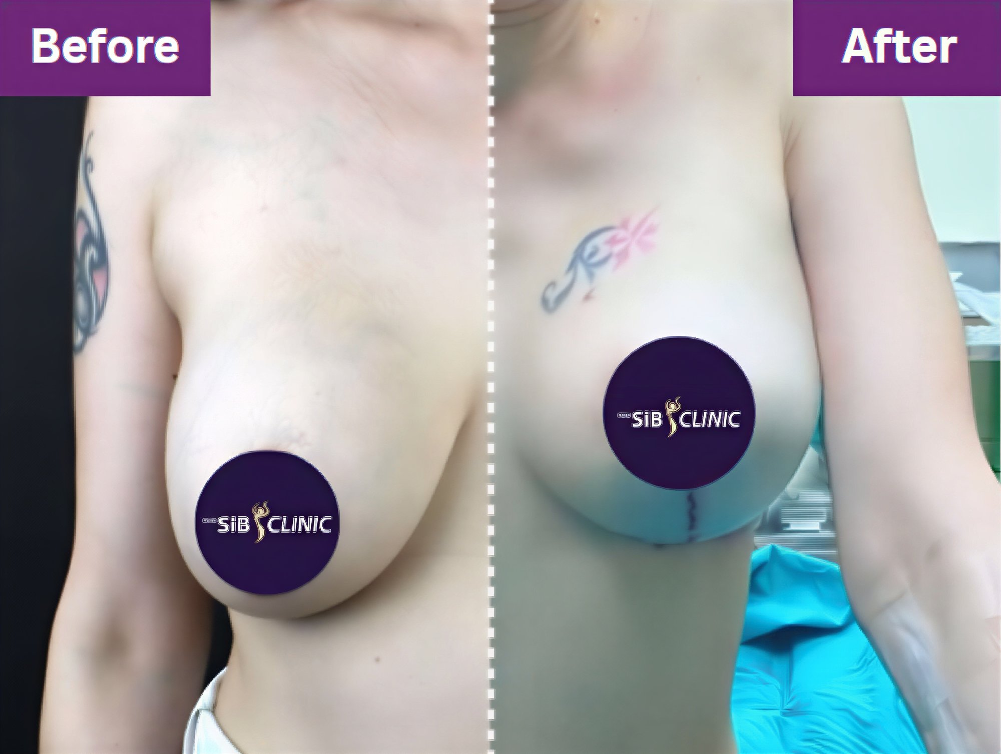 Resultados de lifting de senos antes y después en The SiB Plastic Surgery, mejor contorno