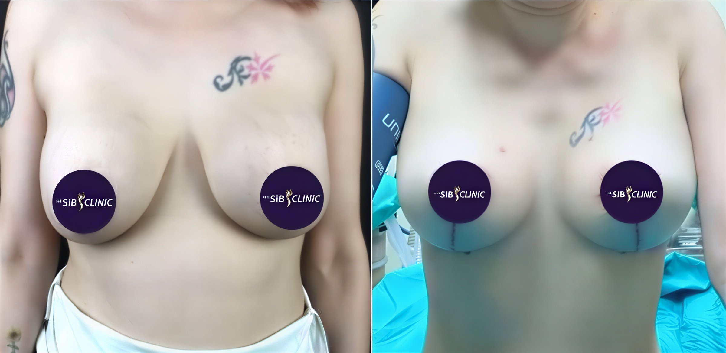 Resultados antes y después de mastopexia en The SiB Plastic Surgery, mejor contorno mamario