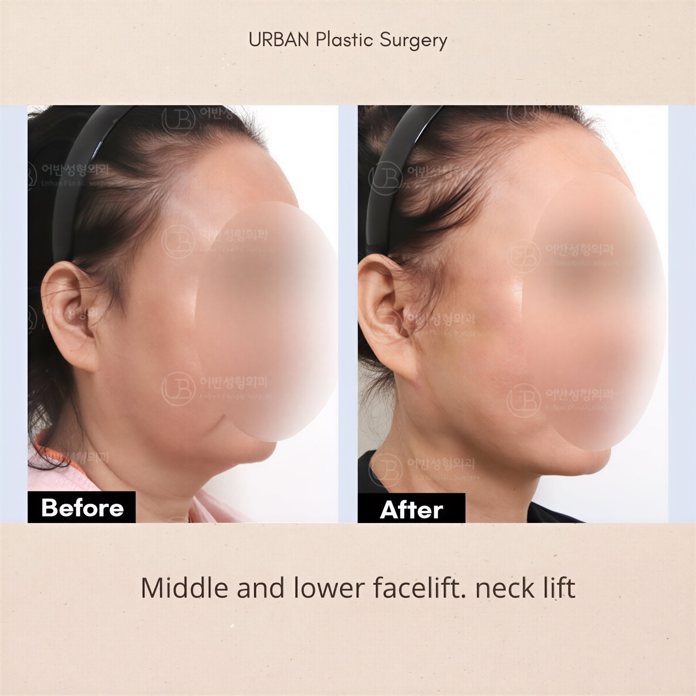 نتائج شد الوجه والرقبة قبل وبعد في URBAN Plastic Surgery مع تحسين واضح للكونتور