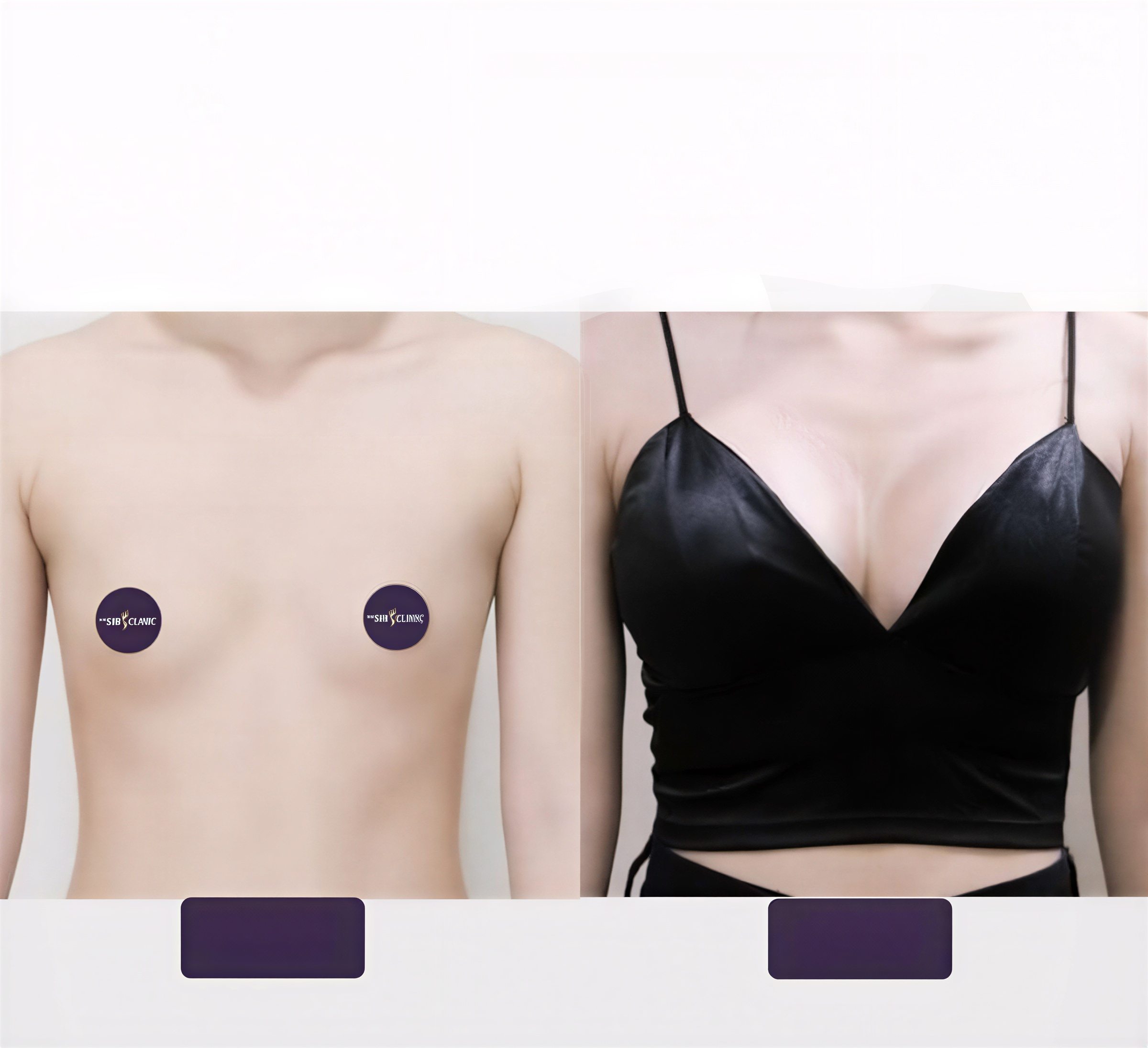Resultados antes y después de aumento de senos en The SiB Plastic Surgery, mayor volumen