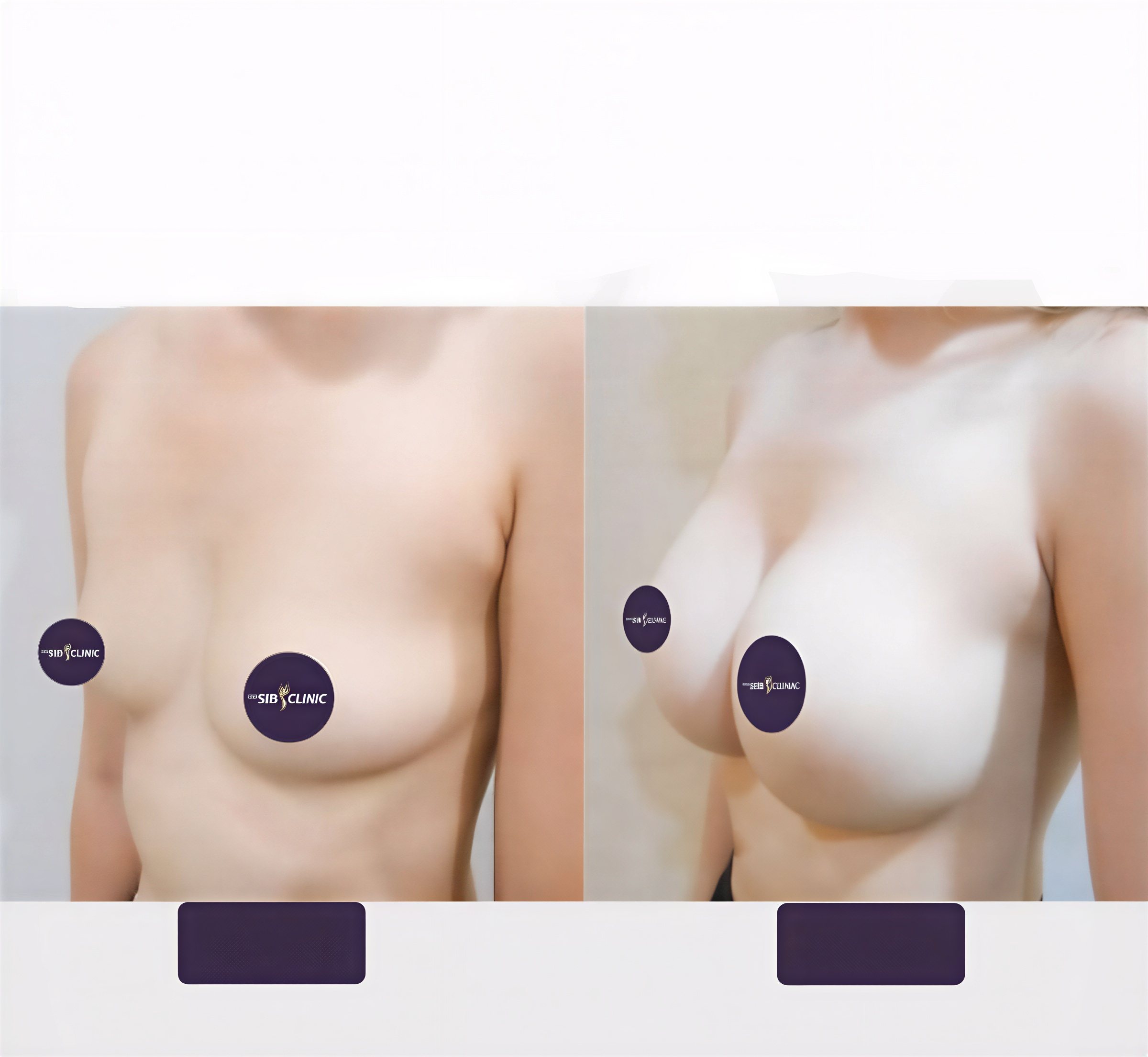 Resultados antes y después de aumento de senos en The SiB Plastic Surgery, forma mejorada