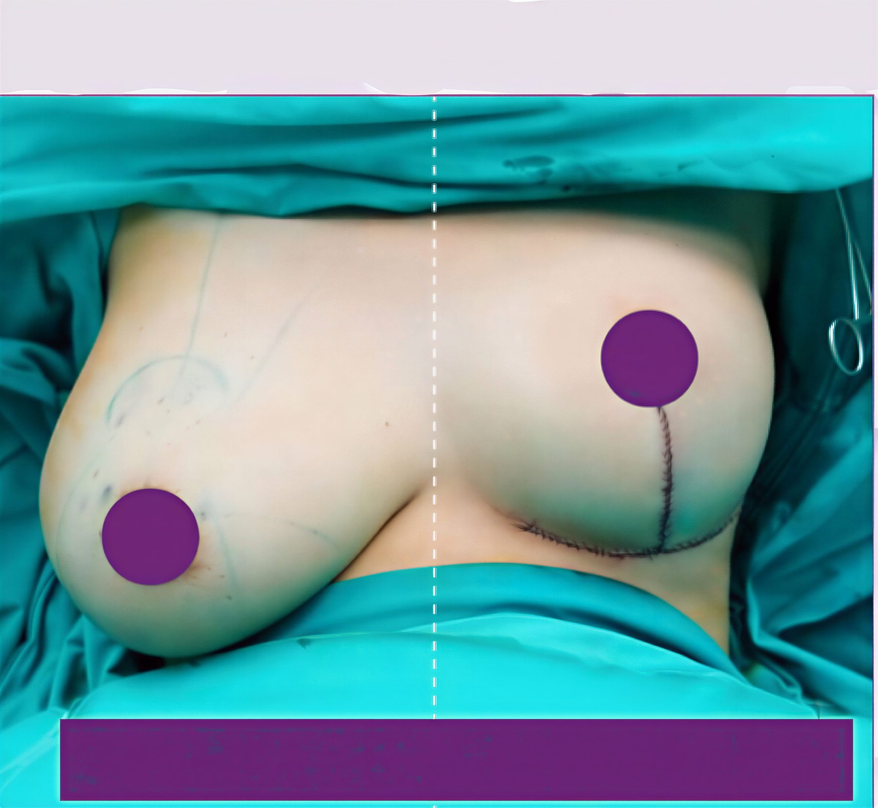 Resultados antes y después de mastopexia en The SiB Plastic Surgery – mejora del contorno mamario