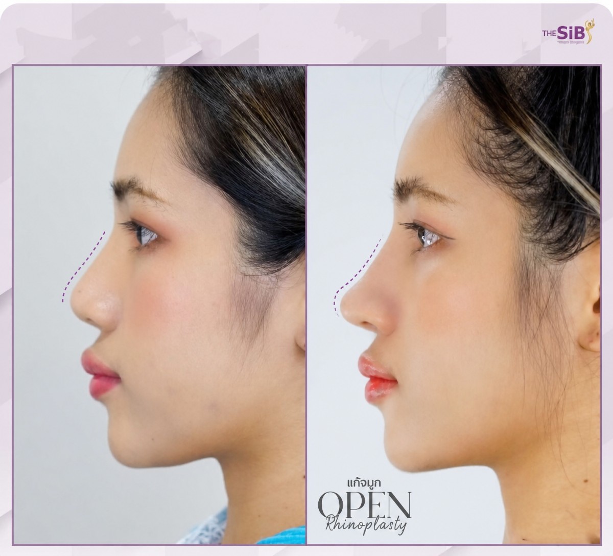نتائج قبل وبعد عملية تجميل الأنف التصحيحية في The SiB Plastic Surgery، إعادة تشكيل الأنف