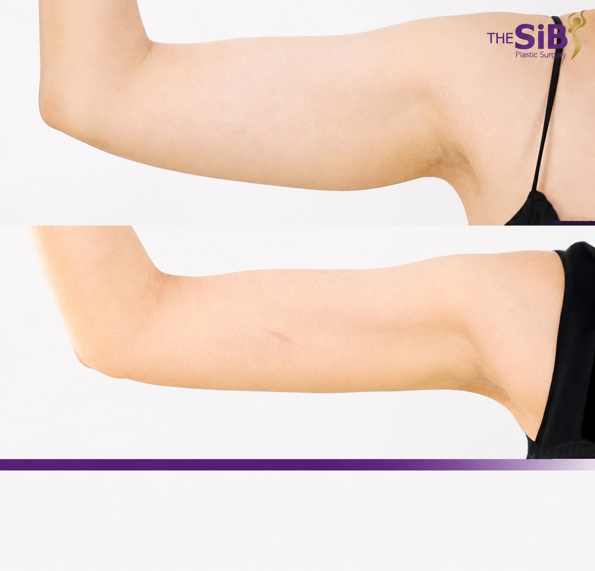 Before and after arm liposuction results at The SiB Plastic Surgery, improved arm contour