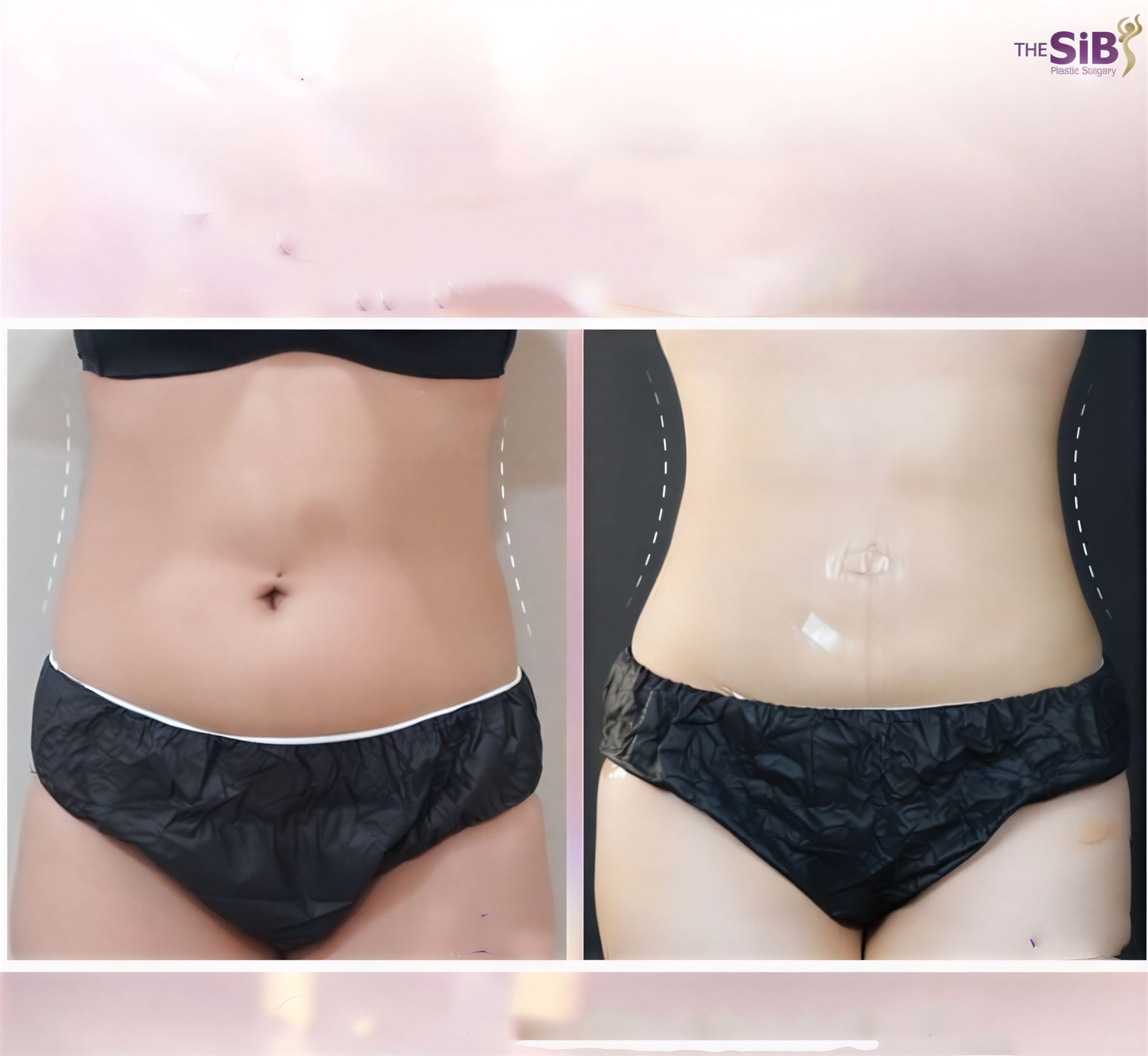 نتائج شفط الدهون قبل وبعد في The SiB Plastic Surgery، تحديد واضح للخصر