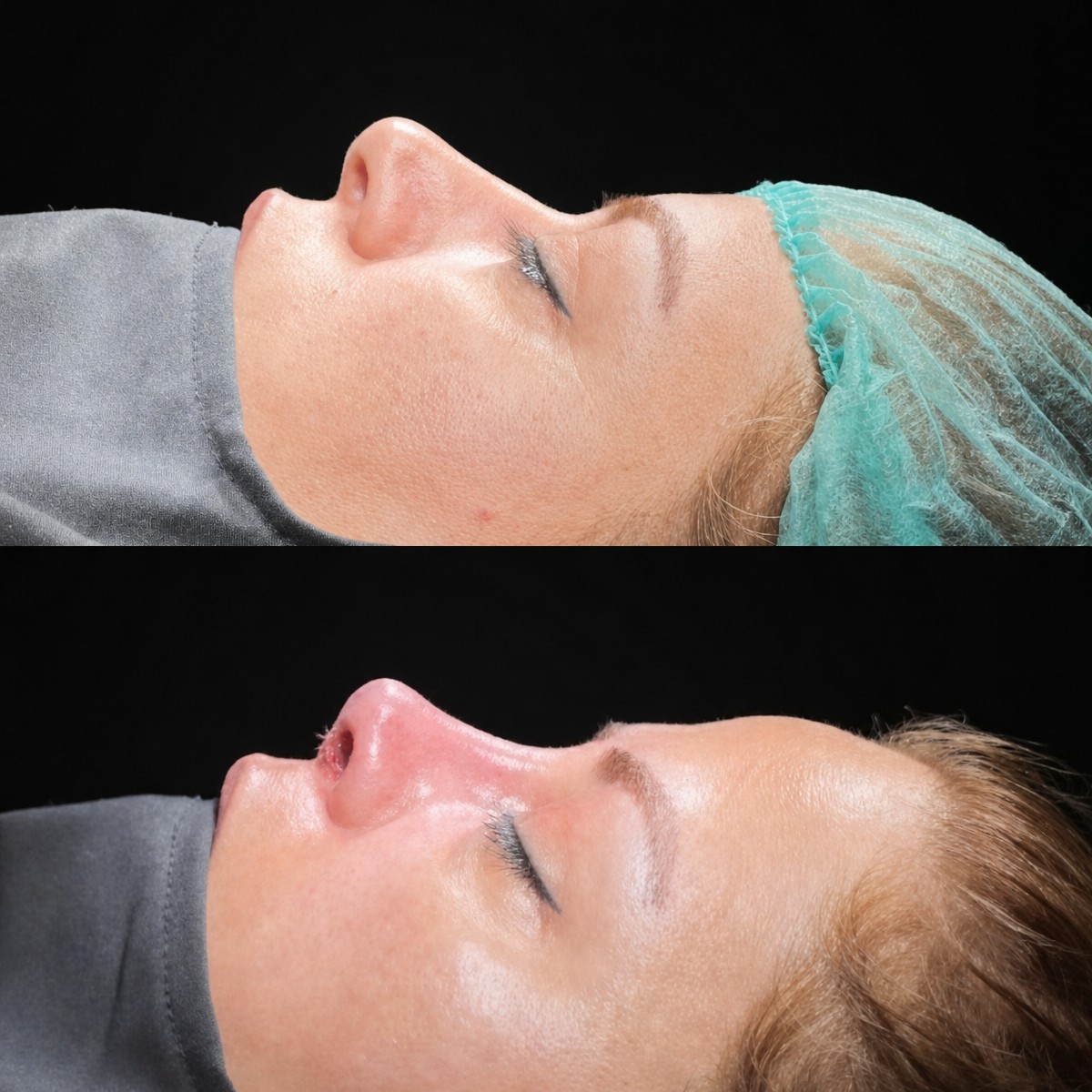 Before and after rhinoplasty results at Medipol Bahçelievler Hospital, improved nose profile