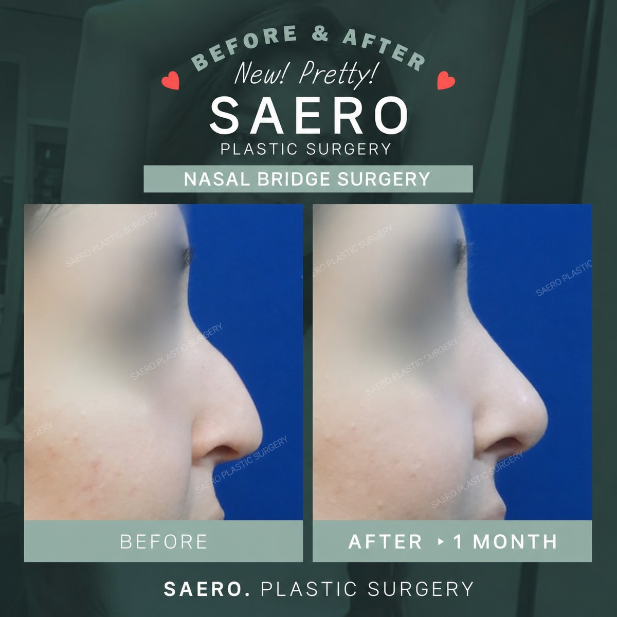Результаты до и после операции на спинке носа в SAERO Plastic Surgery, улучшенный профиль