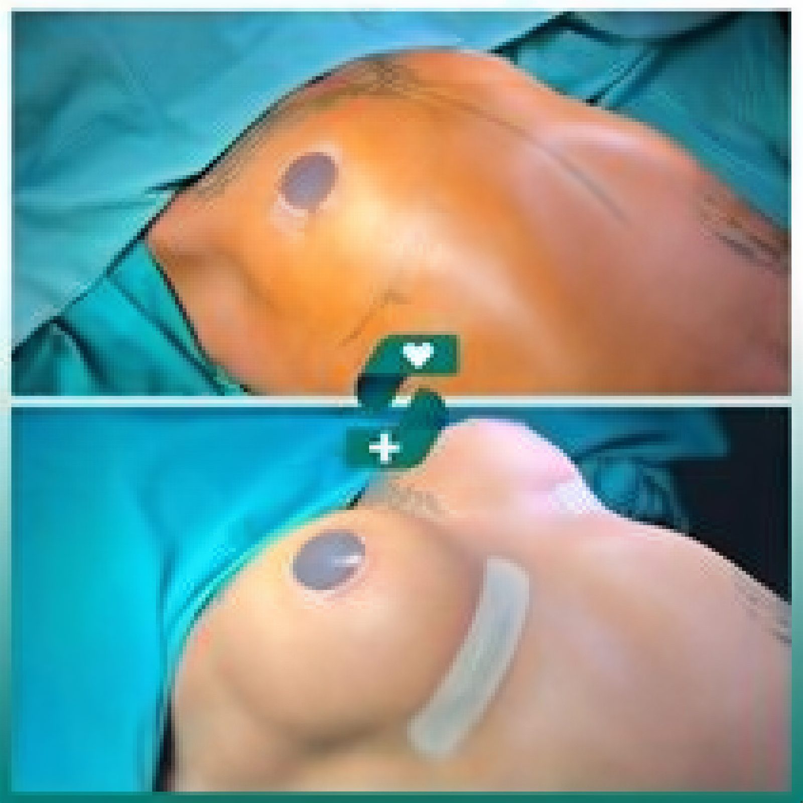 Antes y después de mastopexia con implantes redondos en Soraca Med Istanbul, resultado visible