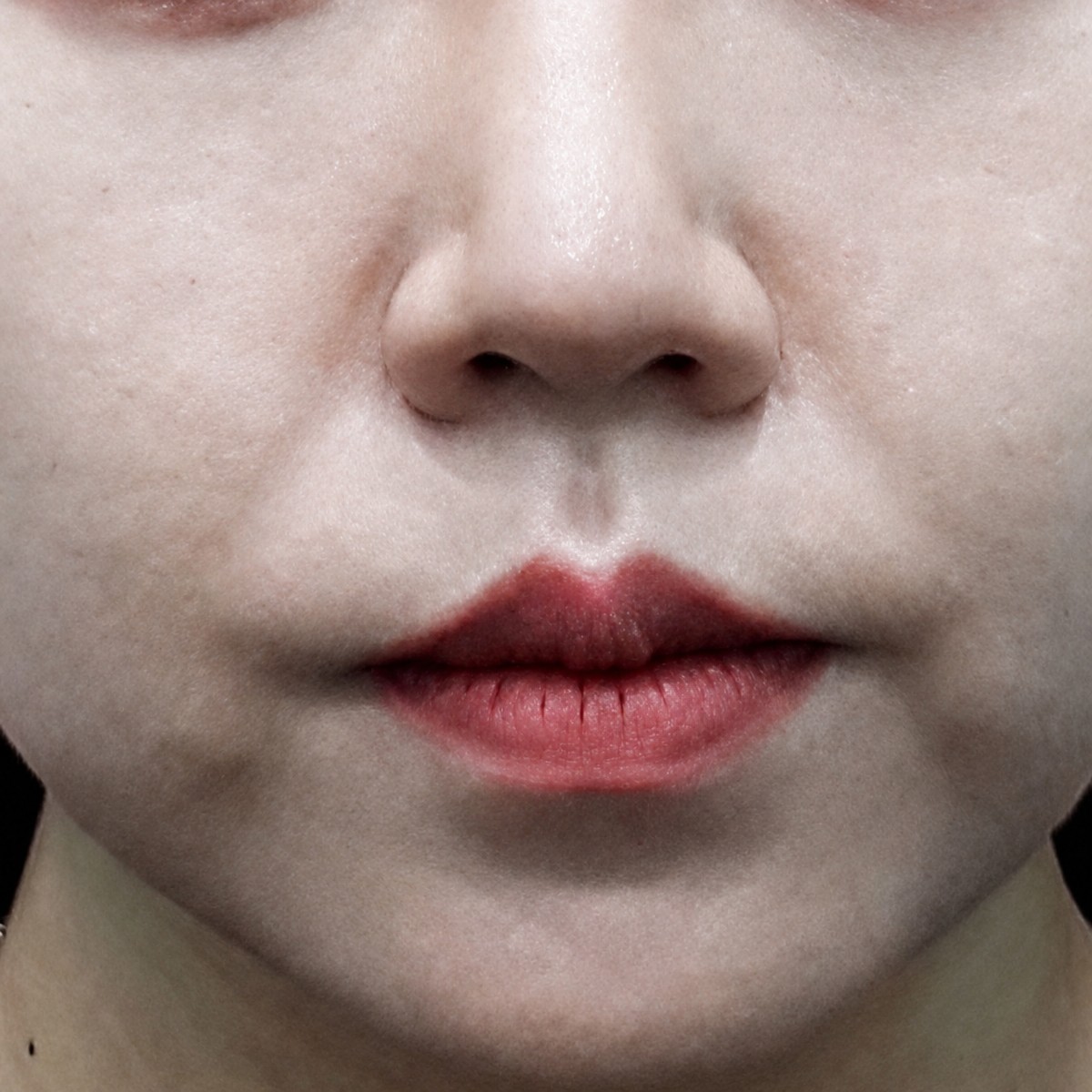 Botox injections result at BIOFACE Clinic, reduced wrinkles and smoother skin around lips