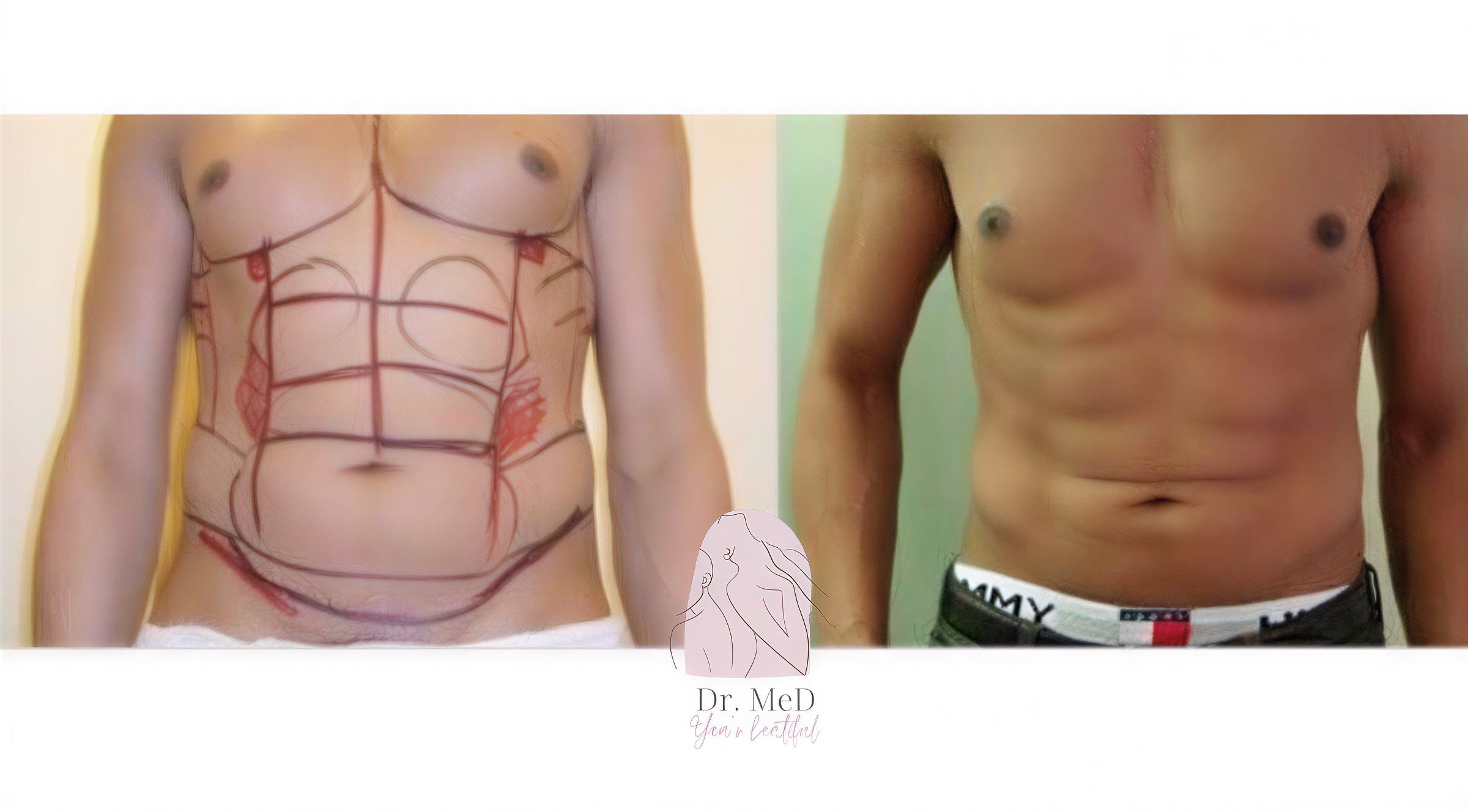 نتائج قبل وبعد فيزر 3 مناطق مع شد البطن في Dr. MED – تحديد عضلات البطن
