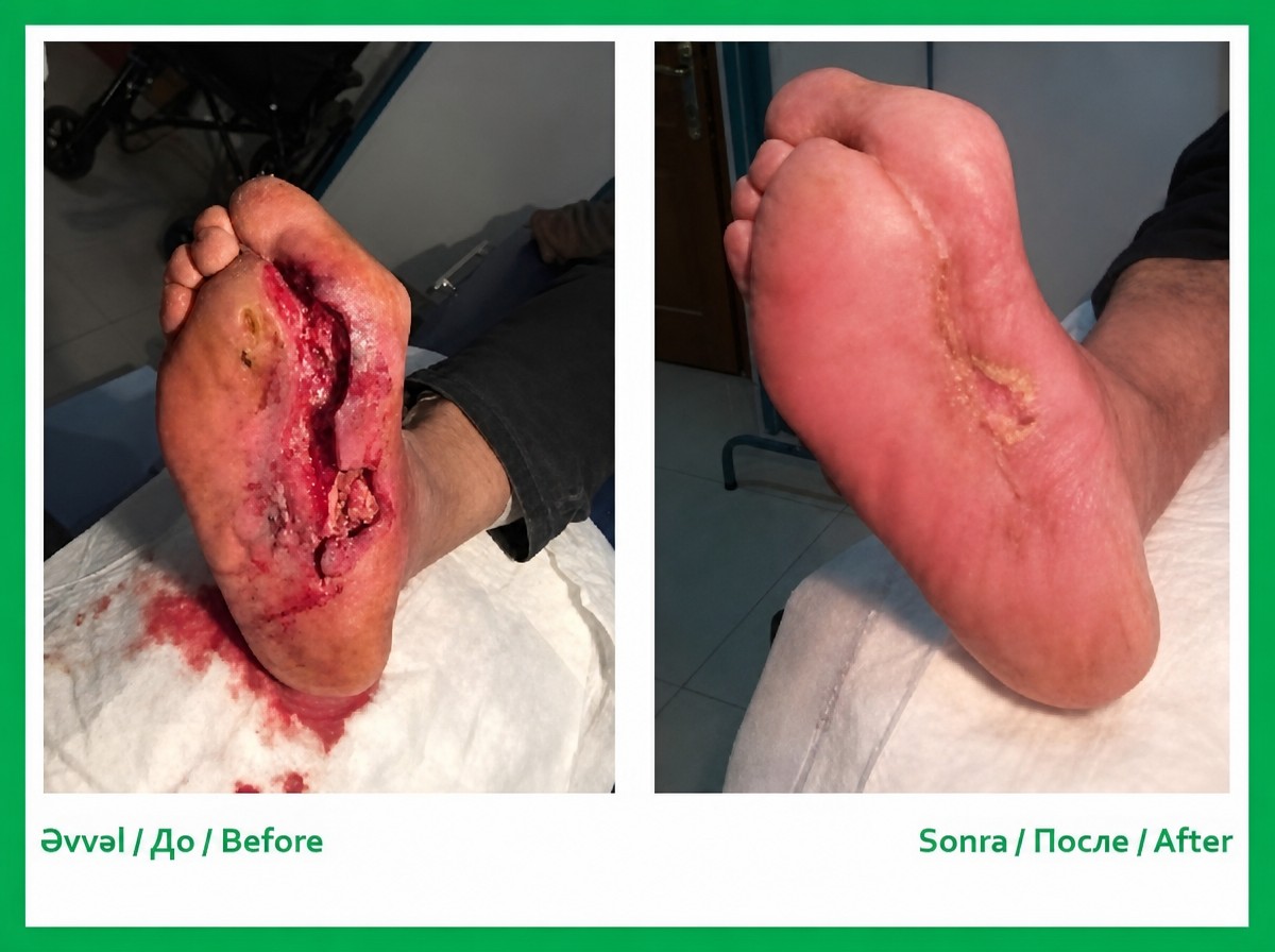 Before and after wound healing results on foot at Biological Medicine - Integrative Health Center Baku