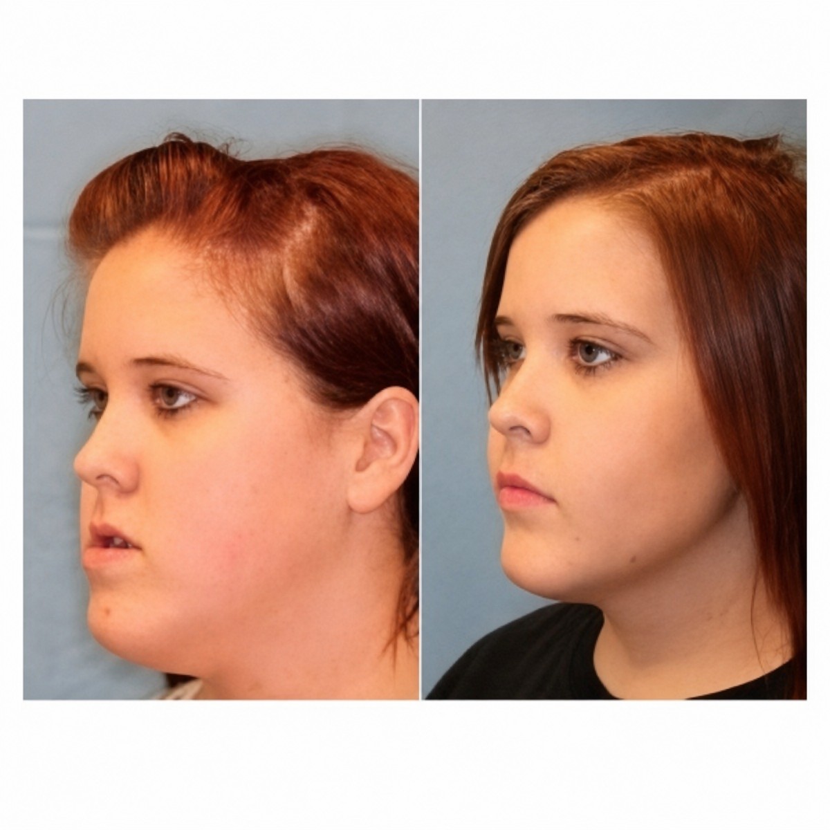 Before and after jaw shaping results at ID Clinic Bangkok, improved jawline contour visible