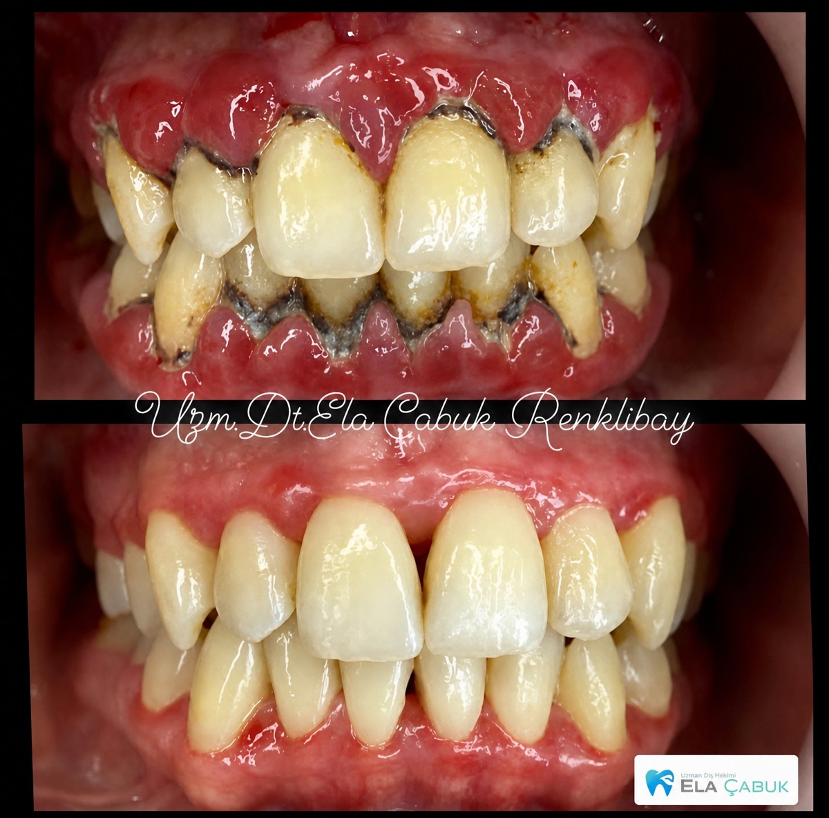 Before and after gum surgery results at Dr. Ela Cabuk Renklibay's Private Dental Clinic