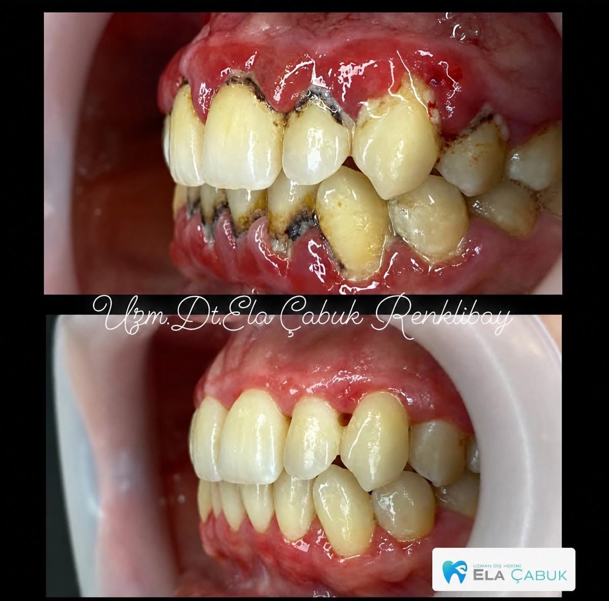 Before and after gum surgery results at Dr. Ela Cabuk Renklibay's Private Dental Clinic